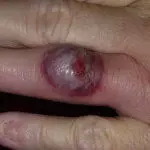 пиодермия на пальце